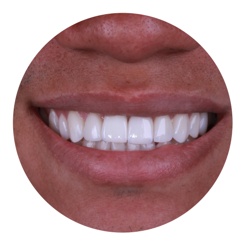 Implantes Dentários