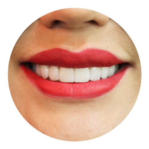 Lentes de Contato Dental