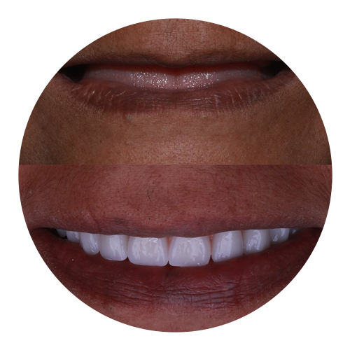 Prótese Dentária